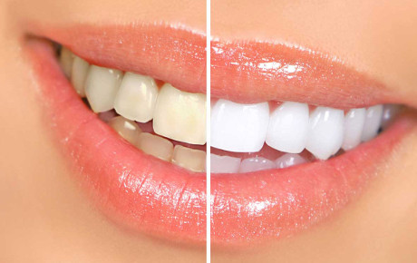 sbiancamento denti prima e dopo